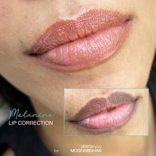 Melanin Lip Correction